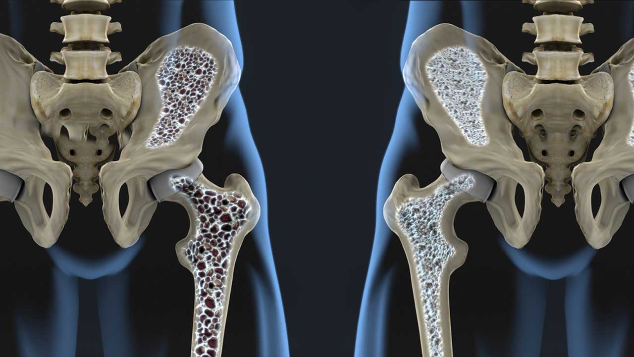 Vitamin D and Calcium for Falls and Fractures: Have We Been Getting It Wrong? Vitamin D and Calcium for Falls and Fractures: Have We Been Getting It Wrong?