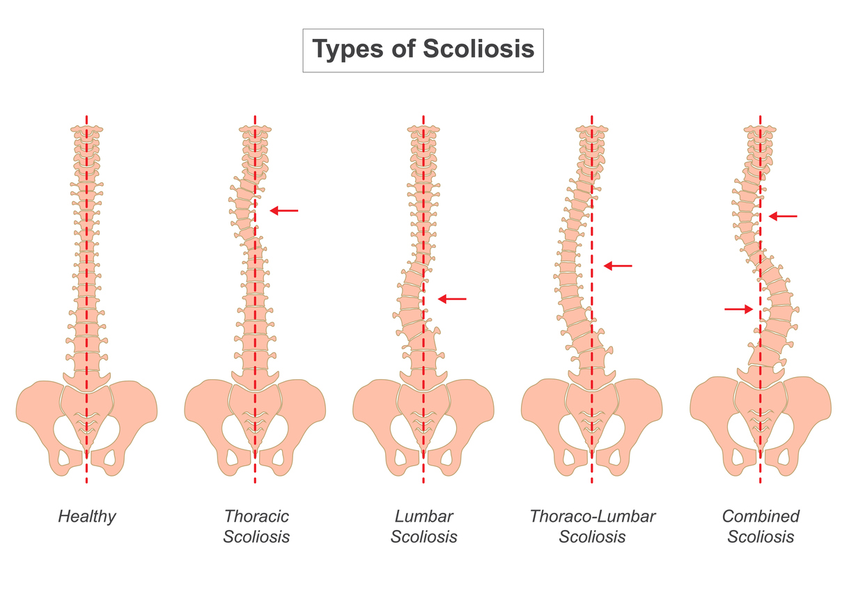 Scoliosis: What It Is, When to Be Concerned, and How Physiotherapy Can Help Scoliosis: What It Is, When to Be Concerned, and How Physiotherapy Can Help